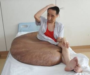 Κίνα: Αφαιρέθηκε ο μεγαλύτερος όγκος που αναπτύχθηκε ποτέ σε άνθρωπο – Zύγιζε 110 κιλά και χρειάστηκαν 9 γιατροί για την επέμβαση!