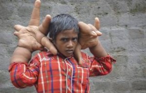  Ινδία: Σοκάρει ο... 8χρονος με τα χέρια που ζυγίζουν 12,5 κιλά (εικόνες) 