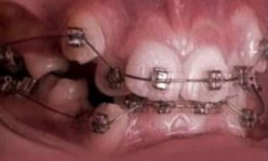Απίστευτο – Δείτε σε γρήγορη κίνηση πως τα σιδεράκια ισιώνουν τα δόντια (βίντεο)
