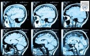  Ανεύρυσμα στον εγκέφαλο: Ποια είναι τα συμπτώματα;