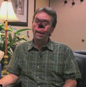 Η συγκλονιστική ιστορία του Donnie Fritts : Ο άνθρωπος με μια τρύπα στο πρόσωπό του - ΒΙΝΤΕΟ 