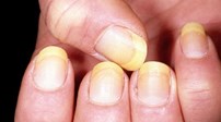 Τα νύχια μας μπορεί να φανερώνουν διάφορες ασθένειες