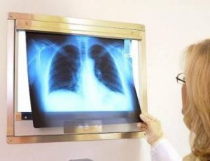 Ύπουλος ο καρκίνος του πνεύμονα! Μπορεί να “κοιμάται” επι 20 χρόνια