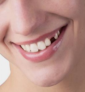 Γιατί πρέπει τα δόντια που εξάγονται να αντικαθίστανται;