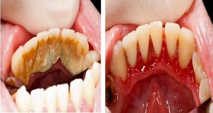 Γίνε ο οδοντίατρος του εαυτού σου! Κόλπα για να καθαρίσεις την πέτρα των δοντιών στο σπίτι σου