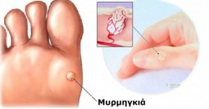 Απαλλαγείτε από Μυρμηγκιές και Κρεατοελιές με ένα Μοναδικό Συστατικό!