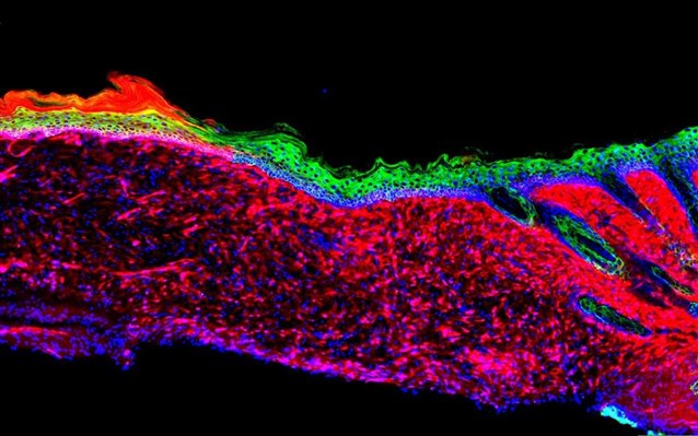 «Επαναπρογραμματισμός» κυττάρων για τη μετατροπή τραυμάτων σε υγιές δέρμα