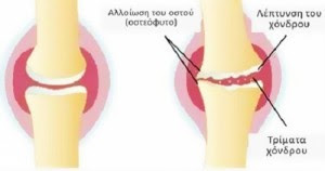 Η συνταγή θαύμα: Μπορεί να θεραπεύσει τους πόνους στις αρθρώσεις σας σε 7 μόλις μέρες!