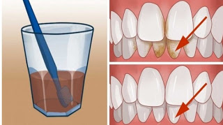 Δείτε φυσικούς τρόπους για να Απαλλαγείτε από την πλάκα στα δόντια σε χρόνο μηδέν